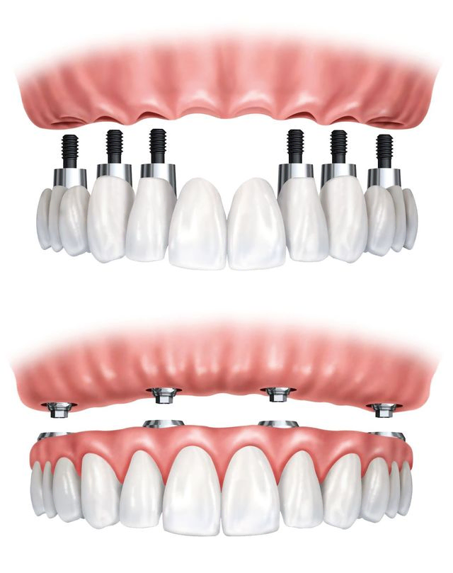 Prótesis dental fija